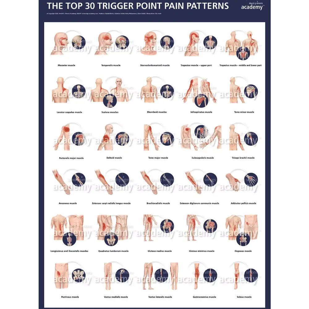 Poster TOP30 des points trigger de la DGSA - Aiguilles de dry-needling